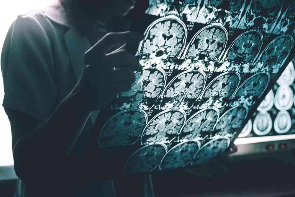 Alzheimer : les premiers essais cliniques d'un médicament innovant vont débuter
