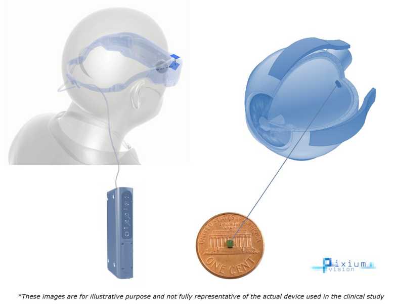 Vision bionique : des chercheurs ont implanté une rétine artificielle chez un patient atteint de DMLA