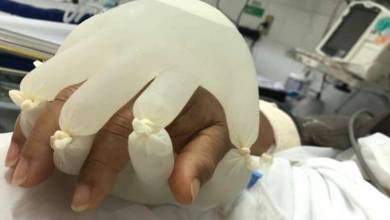 Au Brésil, les soignants utilisent des « petites mains d'amour » pour réconforter les patients isolés
