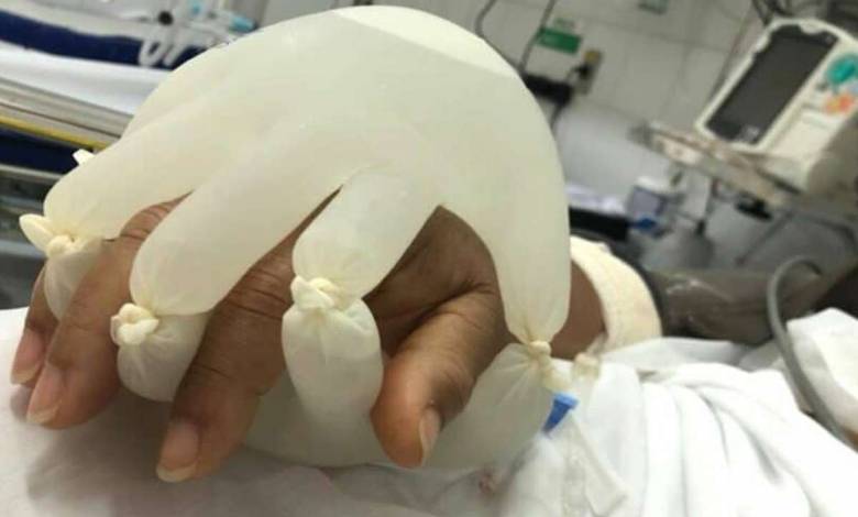 Au Brésil, les soignants utilisent des « petites mains d'amour » pour réconforter les patients isolés