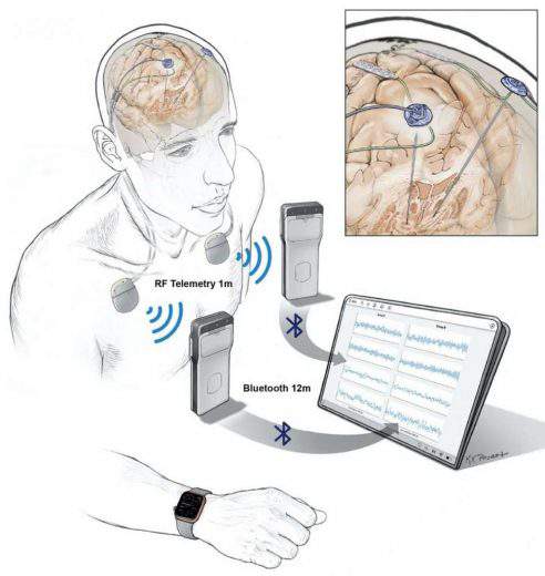 Un appareil innovant capable de surveiller l’activité cérébrale au quotidien... en Bluetooth !