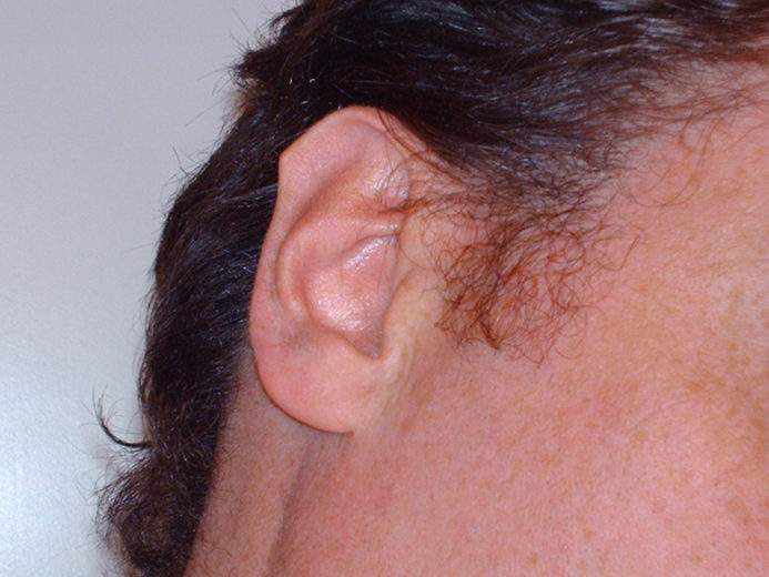 Chine : la chirurgie esthétique pour avoir des "oreilles d'elfe" pour un visage plus fin et plus mince...