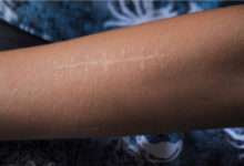 Un médicament anti-cicatrice stimule les cellules productrices de collagène