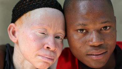 Les persécutions sur personnes souffrant d'albinisme ont augmenté pendant la pandémie alerte l'ONU