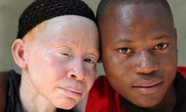Les persécutions sur personnes souffrant d'albinisme ont augmenté pendant la pandémie alerte l'ONU