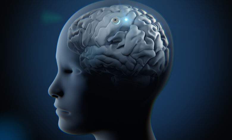 Un implant cérébral conçu pour soigner la dépression.