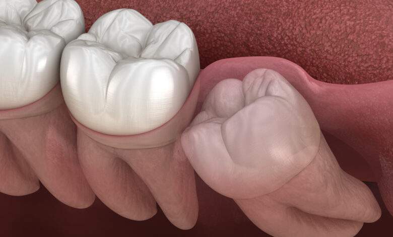 Pourquoi les dents de sagesse apparaissent-elles si tard ?