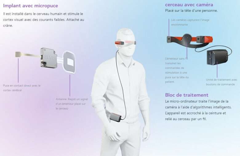 Infographie Implant ELVIS