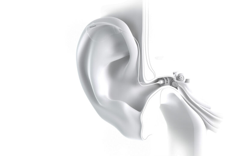 La lentille auditive dans l'oreille