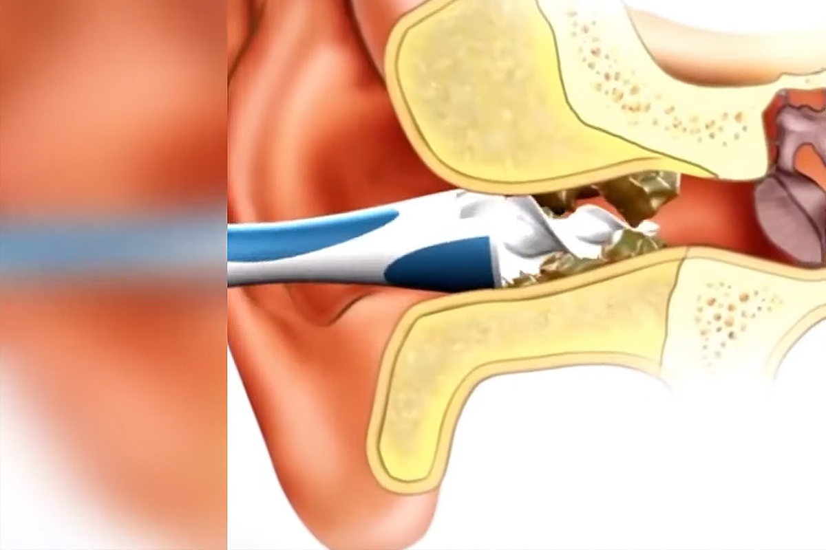 Pourquoi il n'est pas conseillé d'utiliser des cotons-tiges pour se laver  les oreilles ?