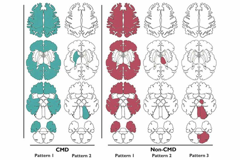 Les schémas cérébraux entre les cerveaux CMD et non CMD ont été comparés.