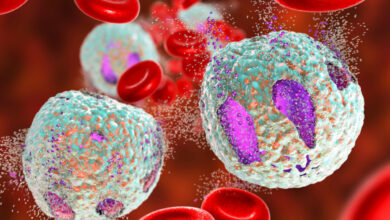 Diapositive de microscope montrant des cellules lymphoblastiques (ALL) aigües, un type de cancer du sang. Concept médical et scientifique avec analyse détaillée des cellules cancéreuses.