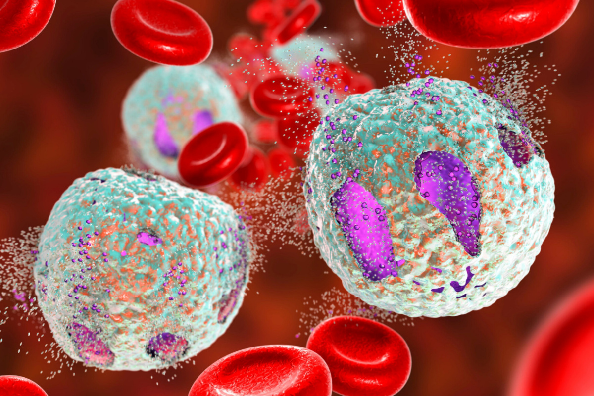 Diapositive de microscope montrant des cellules lymphoblastiques (ALL) aigües, un type de cancer du sang. Concept médical et scientifique avec analyse détaillée des cellules cancéreuses.