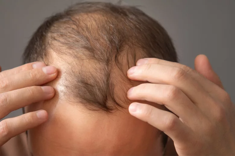 Existe-t-il un remède miracle contre la chute des cheveux ?