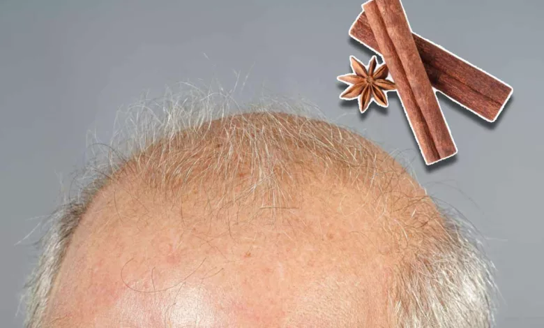 Des chercheurs auraient trouvé un moyen de faire repousser les cheveux avec la cannelle.