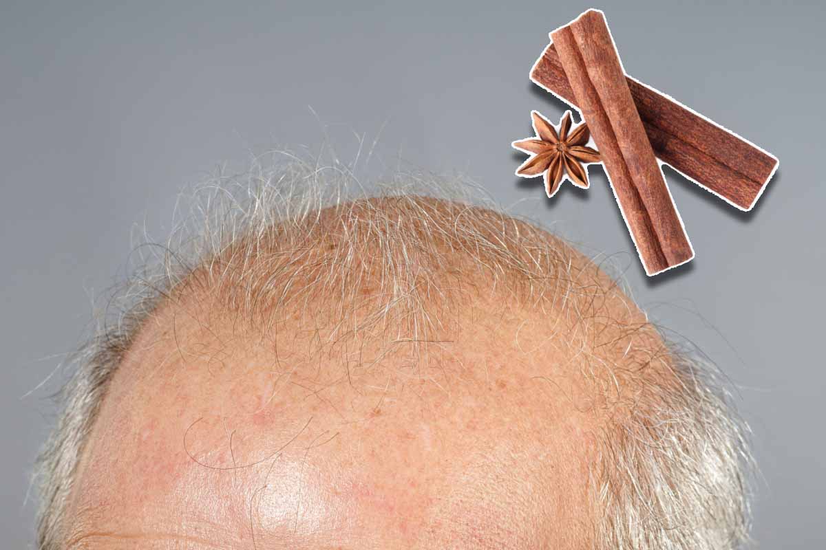 Des chercheurs auraient trouvé un moyen de faire repousser les cheveux avec la cannelle.