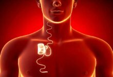 L'invention d'un implant pour traiter efficacement l'apnée du sommeil.