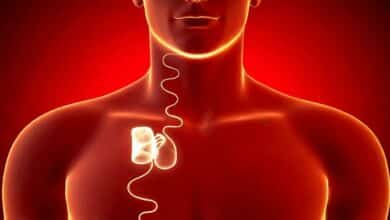 L'invention d'un implant pour traiter efficacement l'apnée du sommeil.