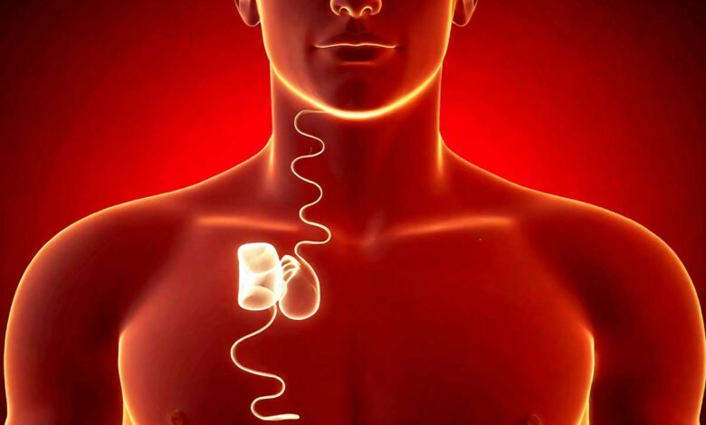 L'invention d'un implant pour traiter efficacement l'apnée du sommeil.