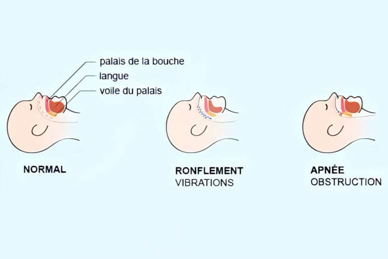 Les mécanismes de l’apnée obstructive du sommeil.