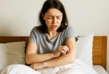 Une femme se gratte après des piqures de punaises de lit.