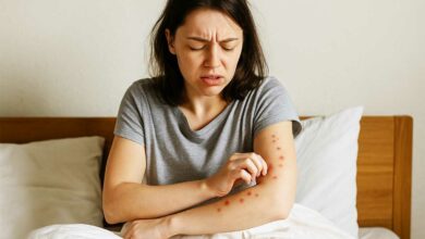 Une femme se gratte après des piqures de punaises de lit.