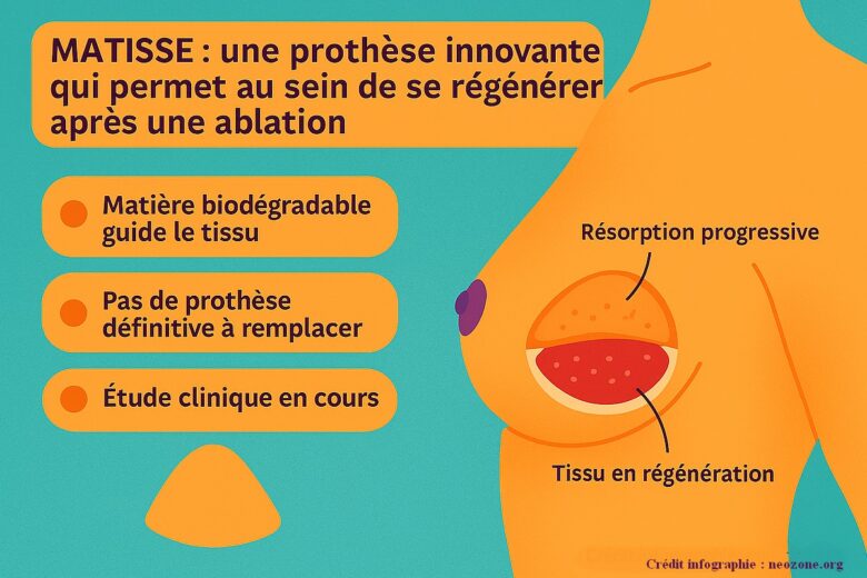 Infographie : MATTISSE, une prothèse innovante qui permet au sein de se régénérer naturellement après une ablation.
