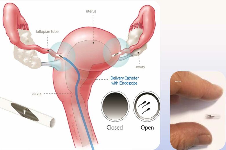 Principe de la valve de contraception.