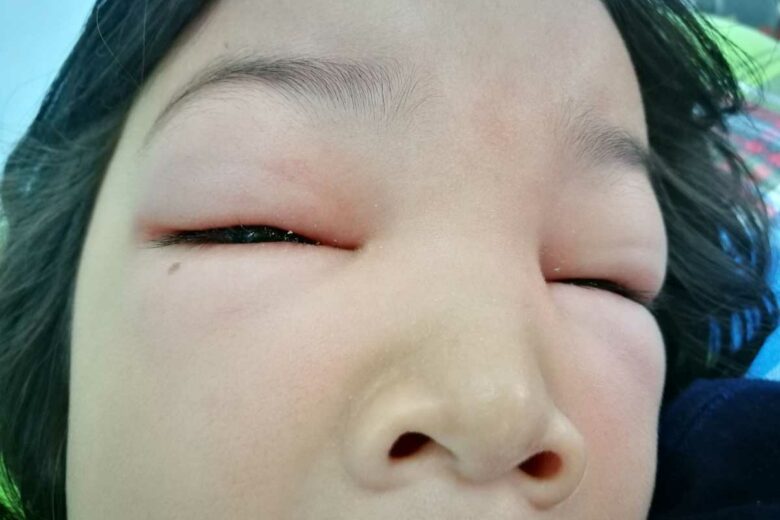 Une jeune fille avec une réaction allergique à une piqure d'instecte.