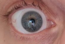 Un œil atteint de kératocône (dégénérescence de la cornée).