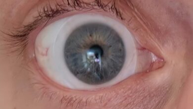 Un œil atteint de kératocône (dégénérescence de la cornée).