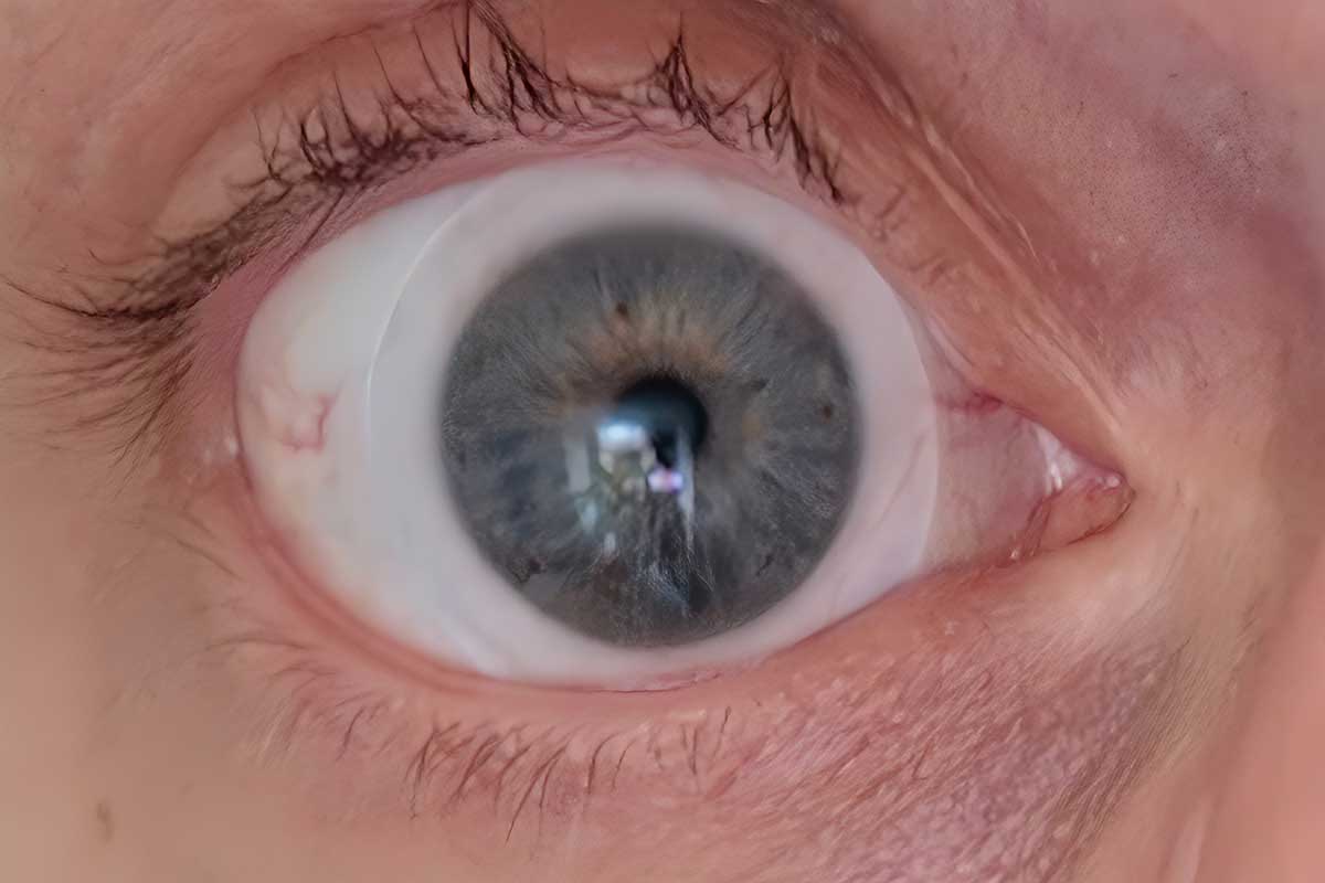 Un œil atteint de kératocône (dégénérescence de la cornée).